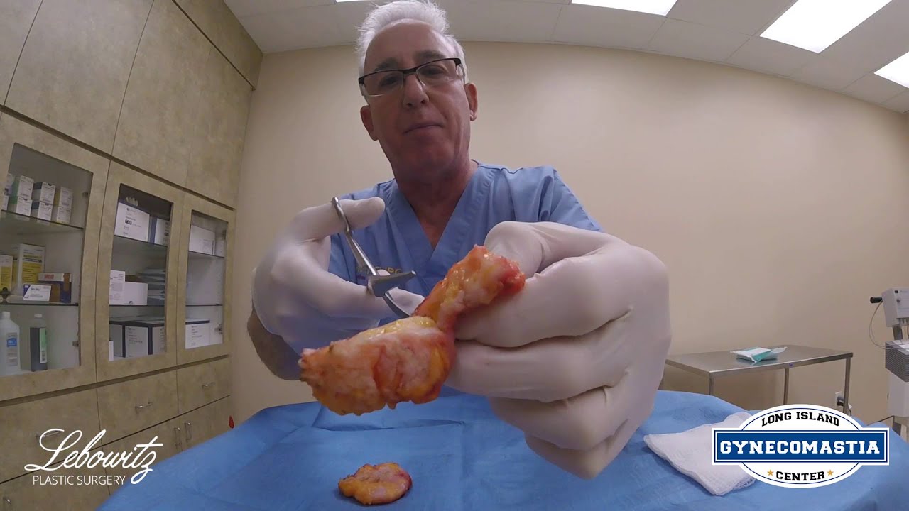 Will Gynecomastia Return / Grow Back After Surgery? Dr. Jonathan Lebowitz Explains!