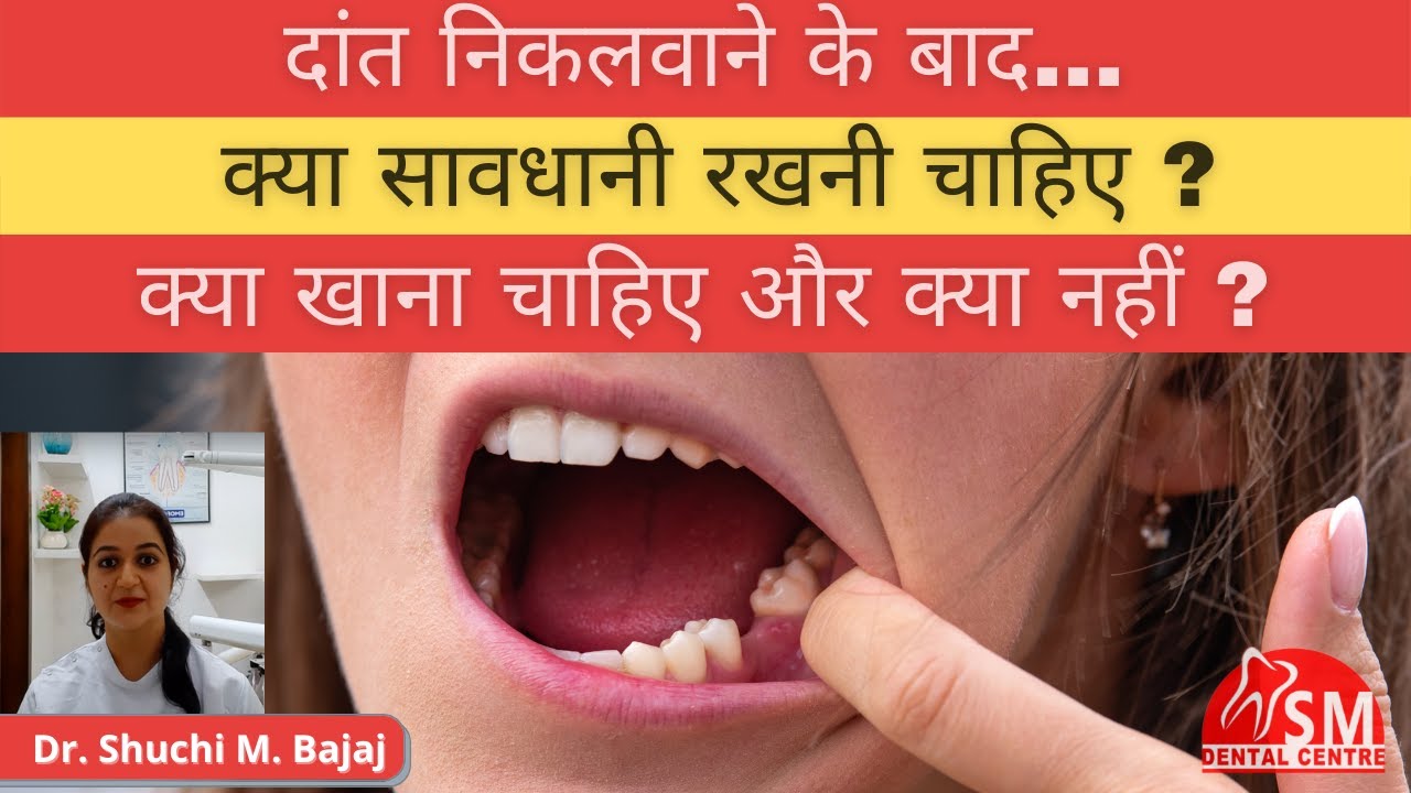 दांत निकालने के बाद क्या करना चाहिए | After tooth-removal care | Food allowed | Dr. Shuchi Bajaj