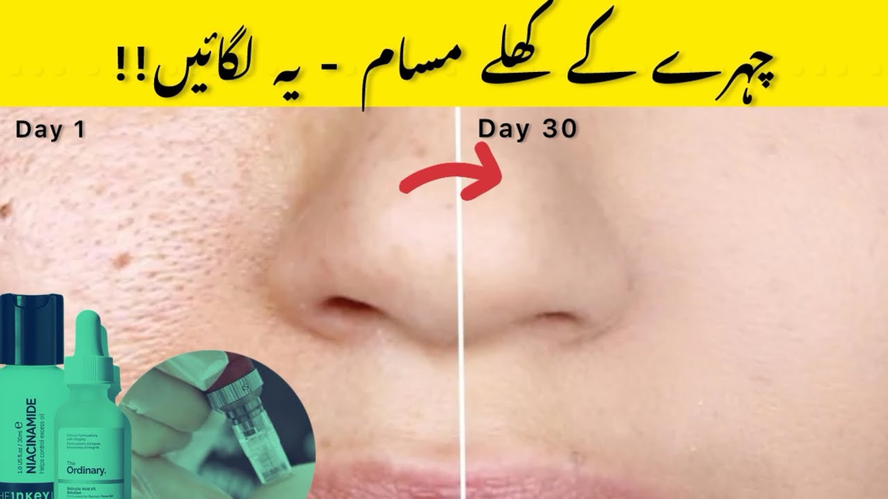 Why You have open pores? Step by step Treatment 100% effective 