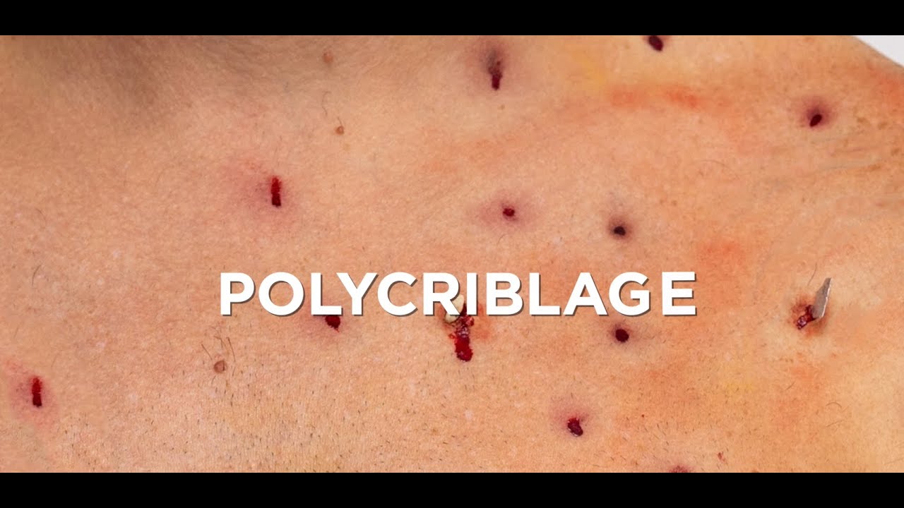 YLEA - Maquillage de Secourisme : Réaliser un polycriblage