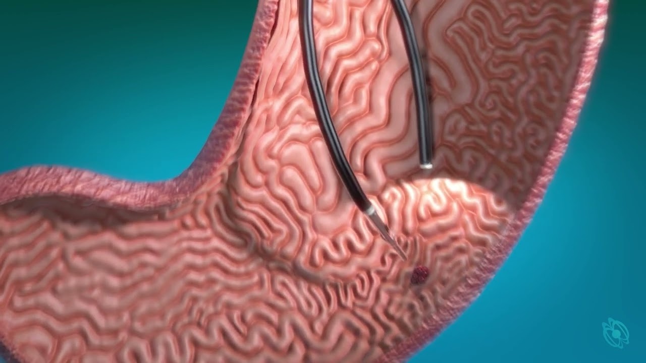 Levita Endoscopic Levita visualization