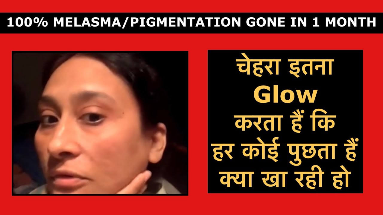 My Face is Glowing so much that everyone asks how ? 100% Melasma/Pigmentation gone in just 1 month