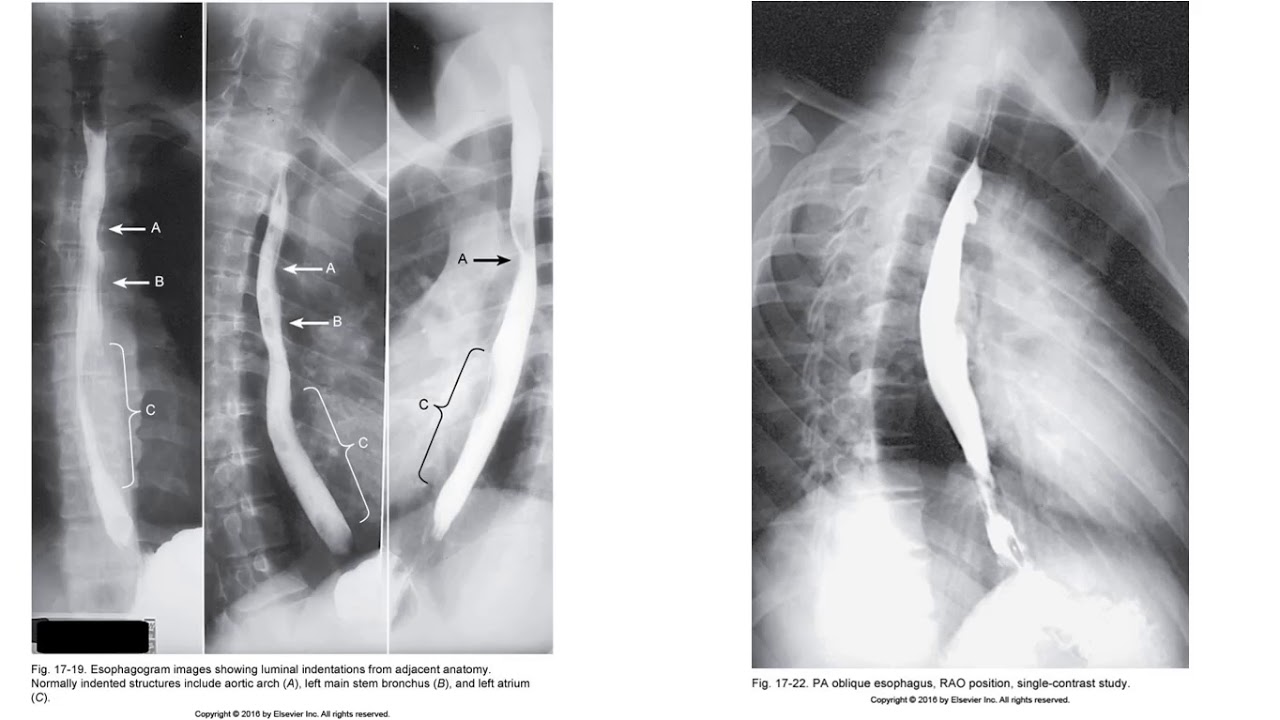 Radiographic Positioning of the Esophagus