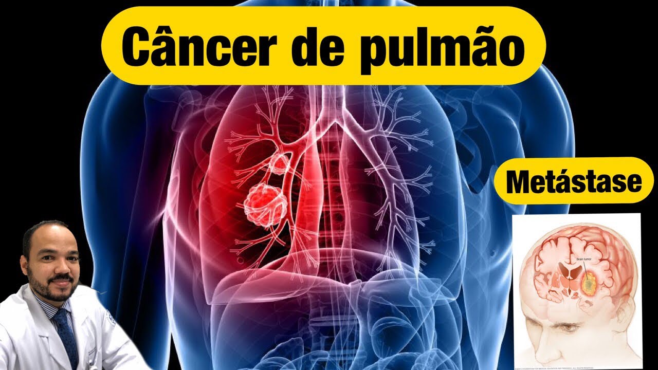 Metástase do Câncer de Pulmão Tem cura ?