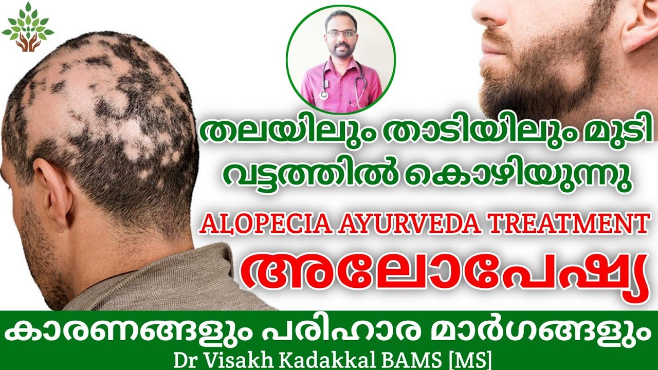 Alopecia - causes,symptoms,treatments | മുടിയും താടിയും വട്ടത്തിൽ കൊഴിയുന്നു - അലോപേഷ്യ | Dr Visakh