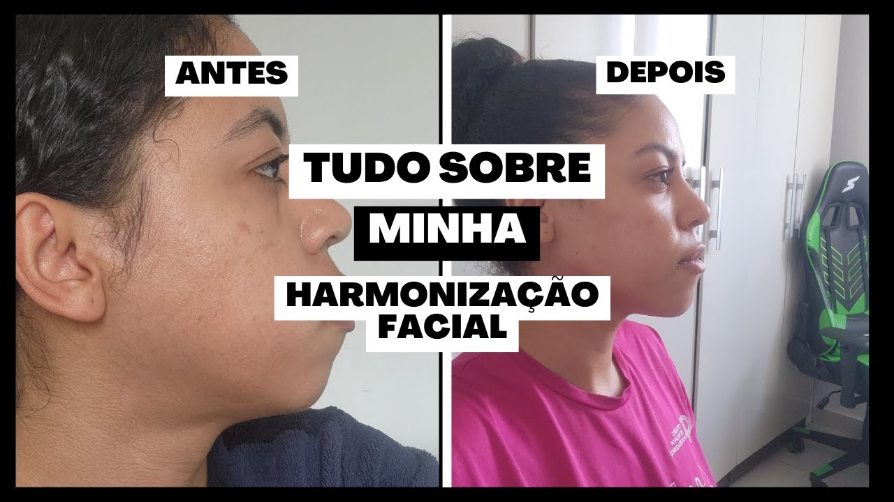 MINHA HARMONIZAÇÃO FACIAL, como é, incômodos, vale a pena?