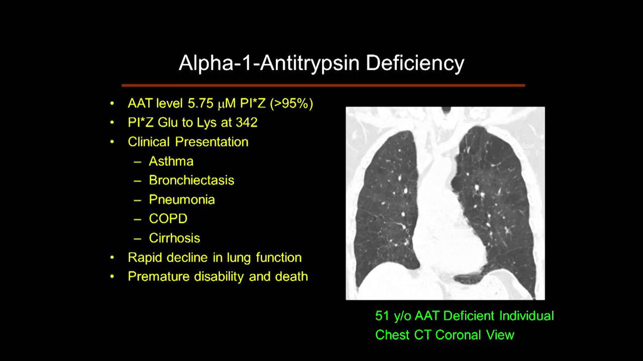 Alpha-1 Antitrypsin Deficiency 101: Lung