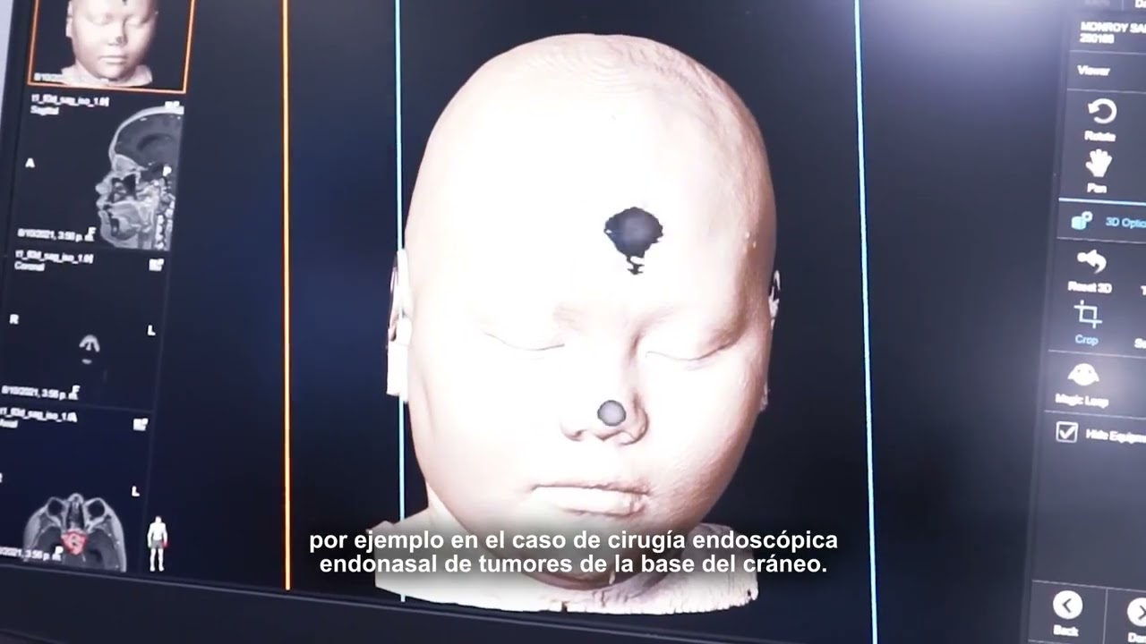 Procedimiento de alta complejidad Neuronavegacion