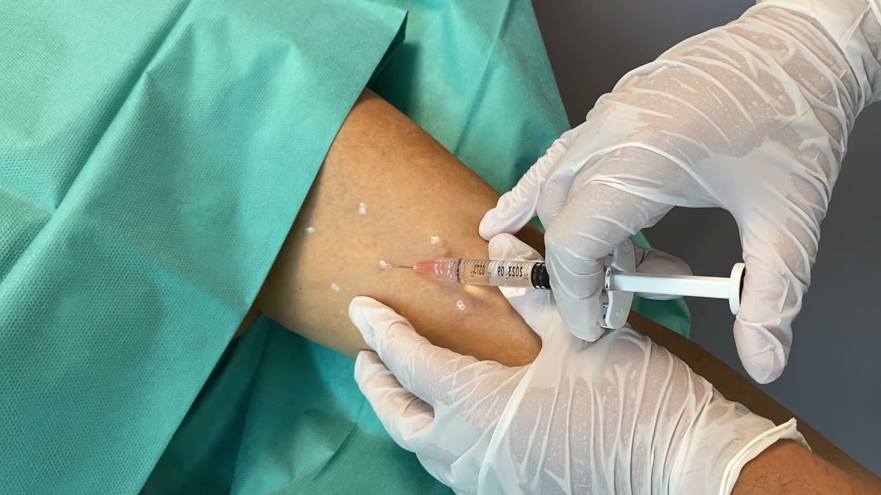 Profhilo Body arms by Dr Gabriel Siquier