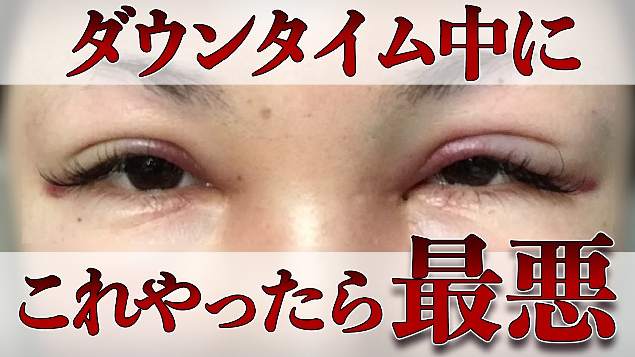 【二重整形・埋没法】ダウンタイム中に絶対やってはいけないことトップ3を徹底解説