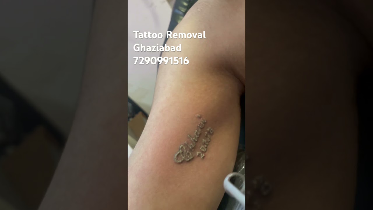 Permanent Tattoo Removal #tattoo #tattooremoval #bodyink #tattooartist #tattooideas #piercing ￼