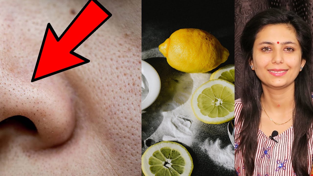 BLACKHEAD REMOVAL AT HOME | Home Remedy Blackhead Hatane ke lie | Dr Upasana Vohra