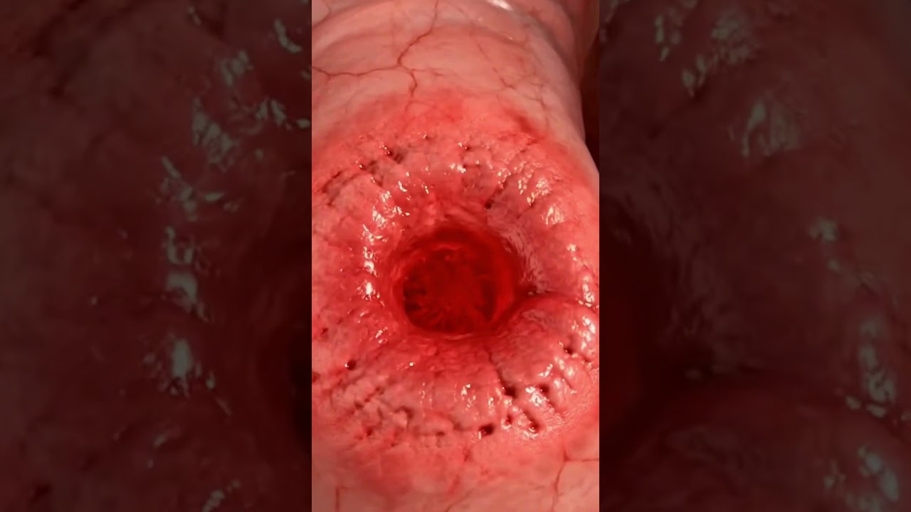 Stomach ulcers: See how the stomach ulcerates from the inside | 3D Animation