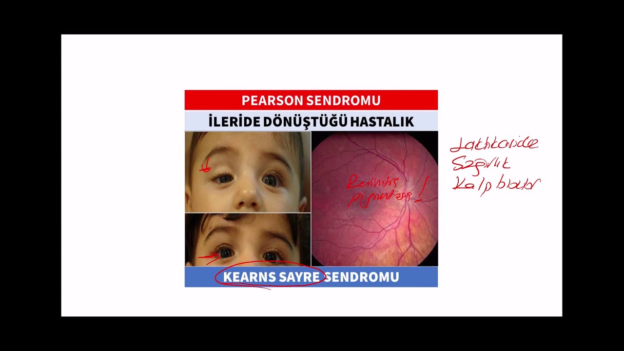 Hipoplastik Anemiler | Stage Doctors Pediatri Örnek Ders Videosu