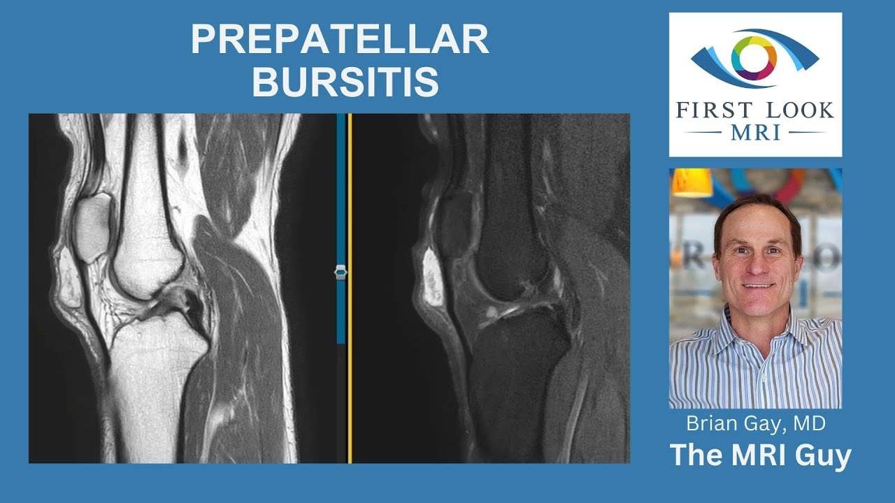 Prepatellar Bursitis