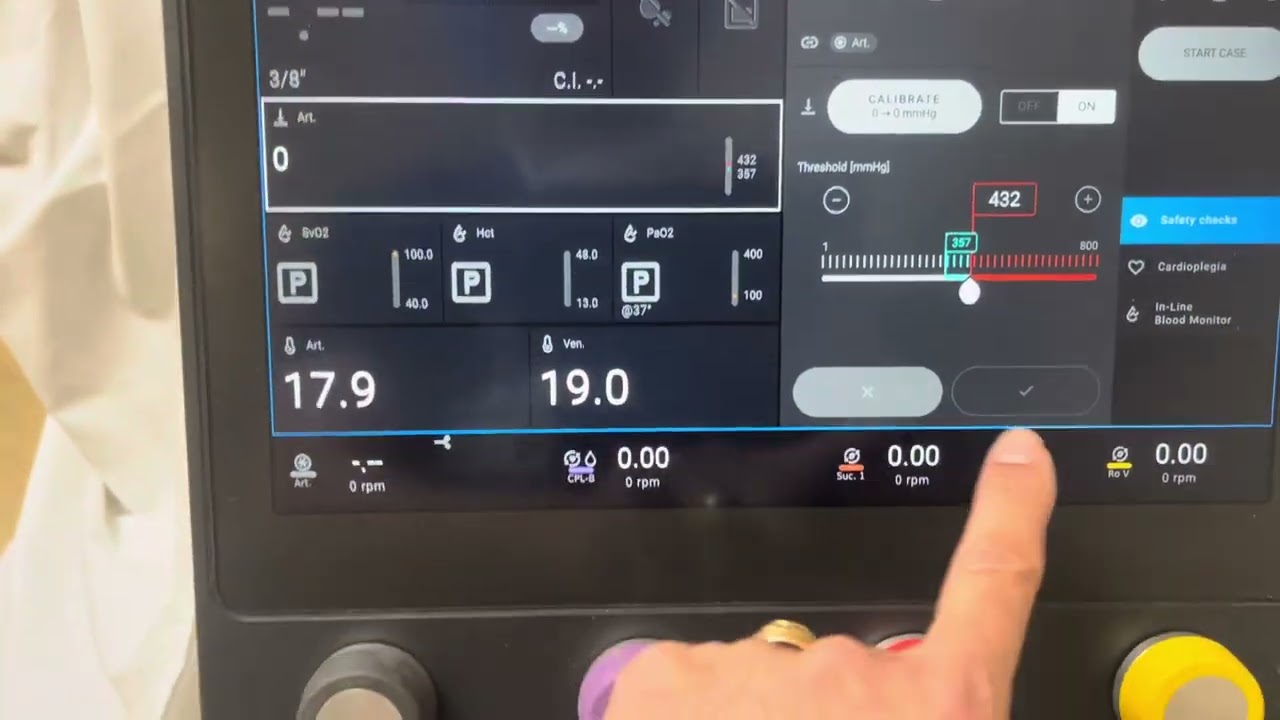 What the Thomas program looks like on the essenz heart lung machine