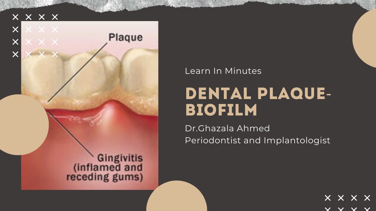Dental Plaque   Biofilm Way of Life