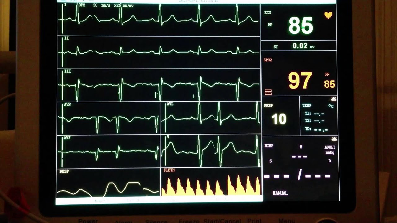 ECG - Extrasystole