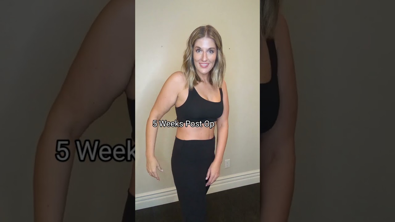 Skin Removal After 100+ Pound Weight Loss