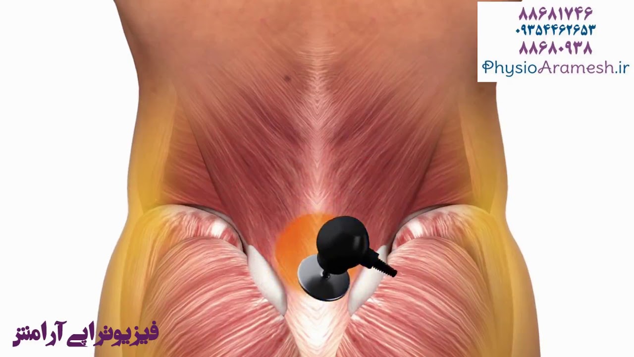 فیزیوتراپیست صادق زراعتکار، تکارتراپی تریگر پوینت