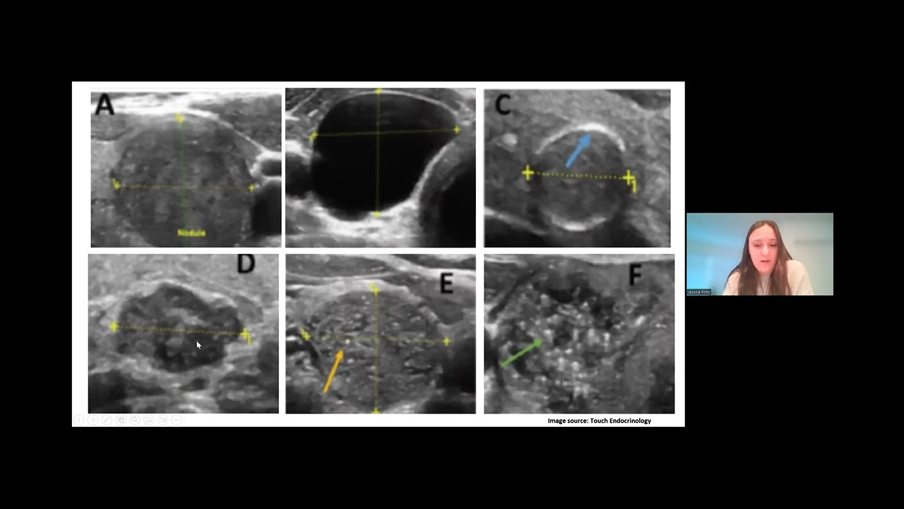 AHD Thyroid Nodules J Pinto