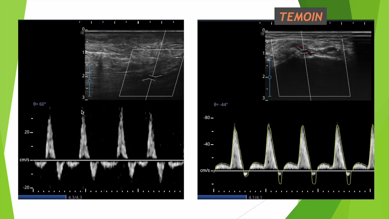 Aspect d'une médiacalcose au doppler