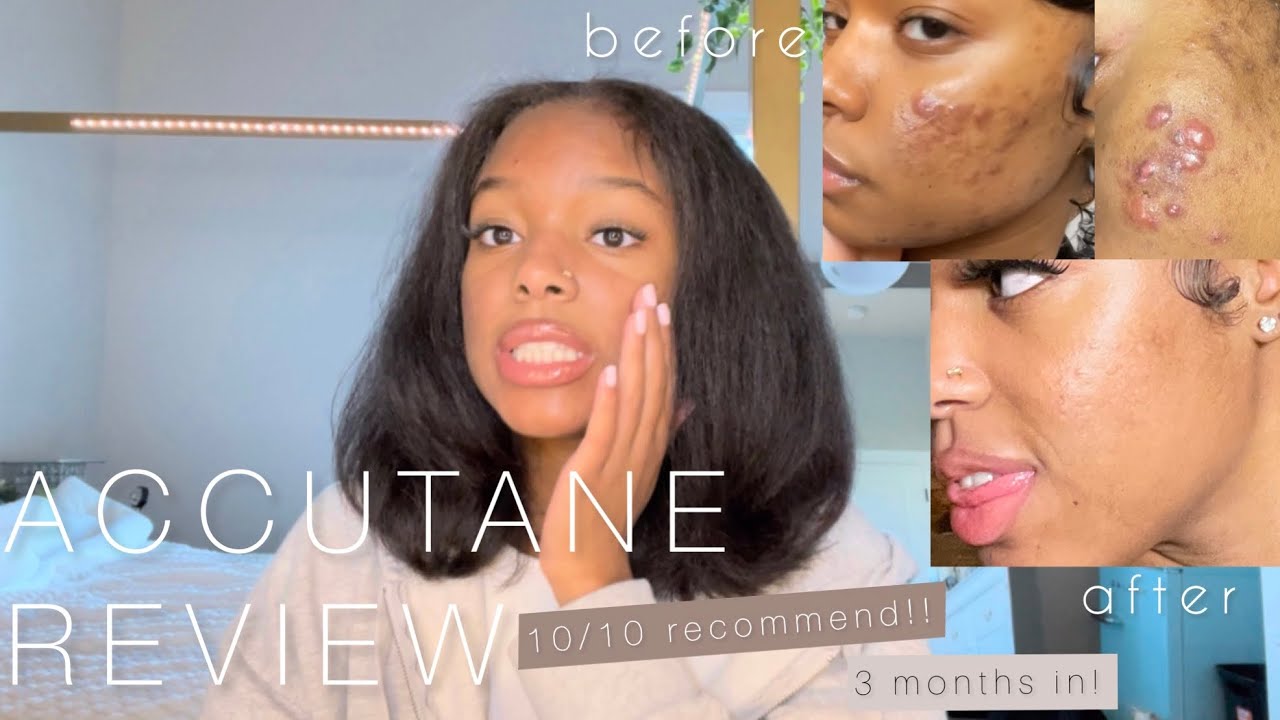 ACCUTANE REVIEW | 3 Month Update!