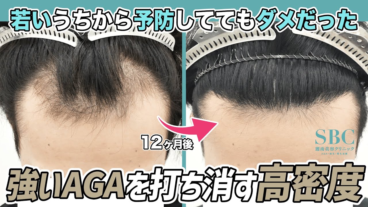 【M字救済】20代内服限界→植毛で1年後激変【2100株】