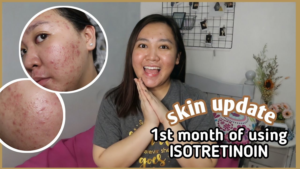 SKIN UPDATE ♡: 1ST MONTH OF MY ISOTRETINOIN JOURNEY