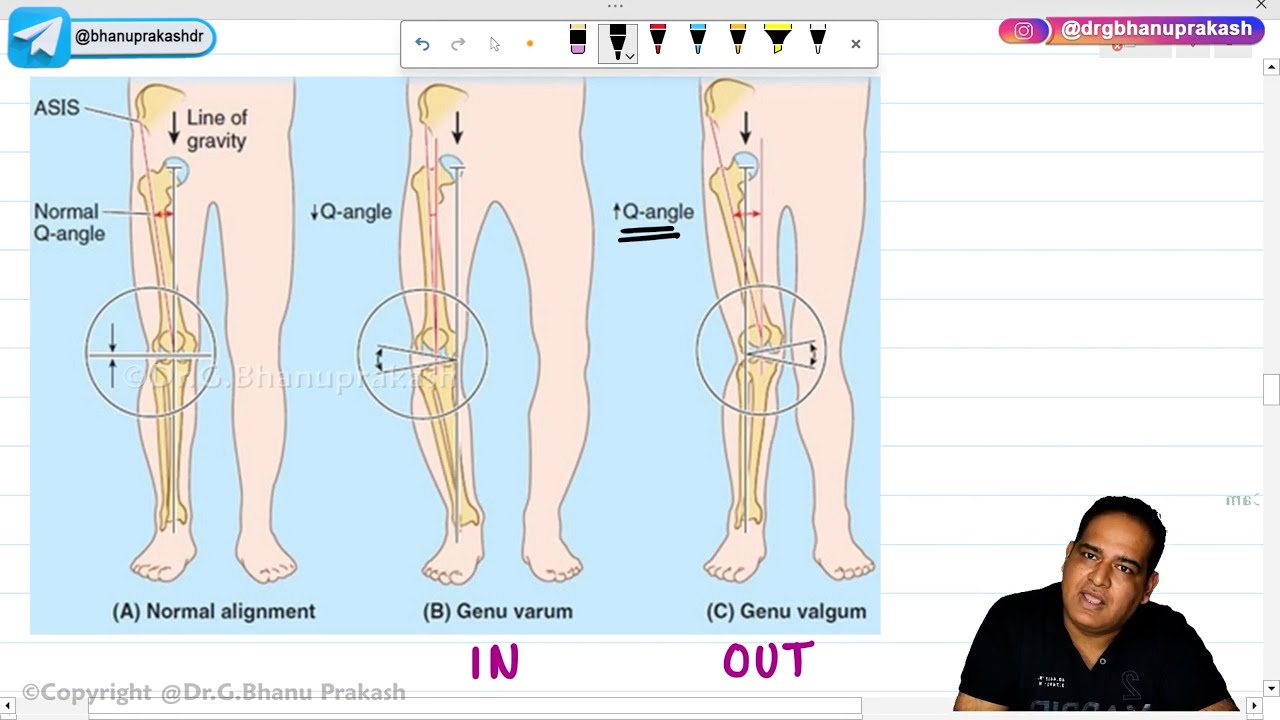 Valgus And Varus Deformities (Hindi) : Orthopedic Lectures 🦵🩺
