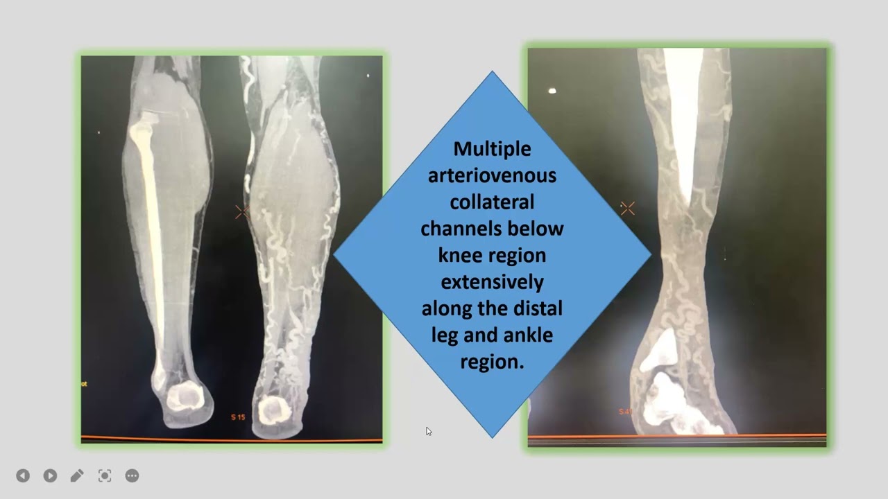 CTBUZZ2023-Dr.Rajkuvar. D. Koparde: Klippel Trenaunay syndrome A Case Report