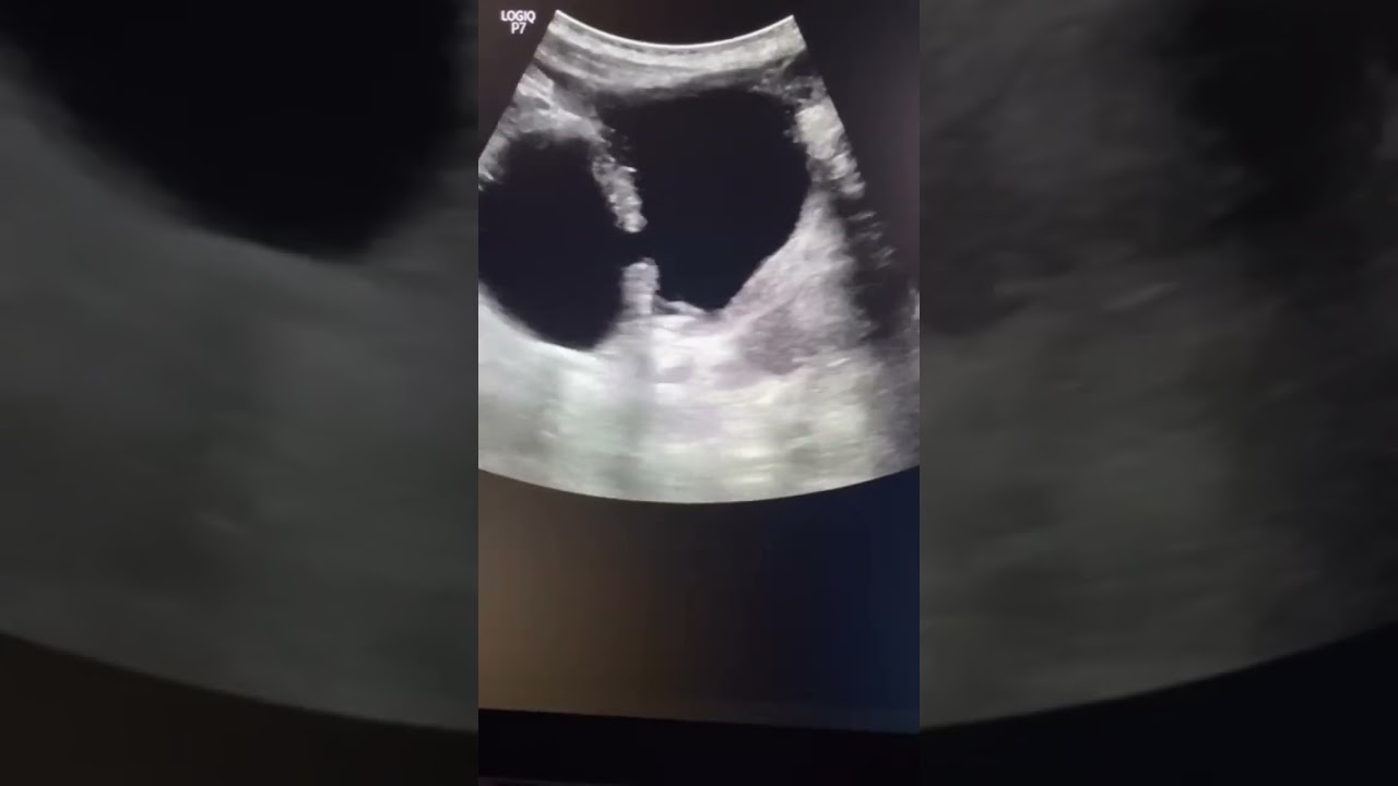 Bladder diverticulum#imaging #learning #ultrasound #medicalimaging