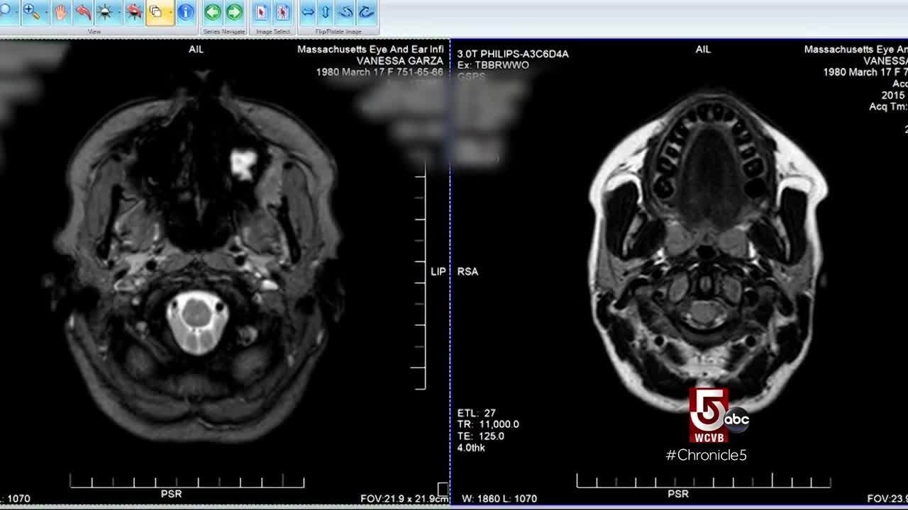 The Choice of Her Life: The AVM Diagnosis