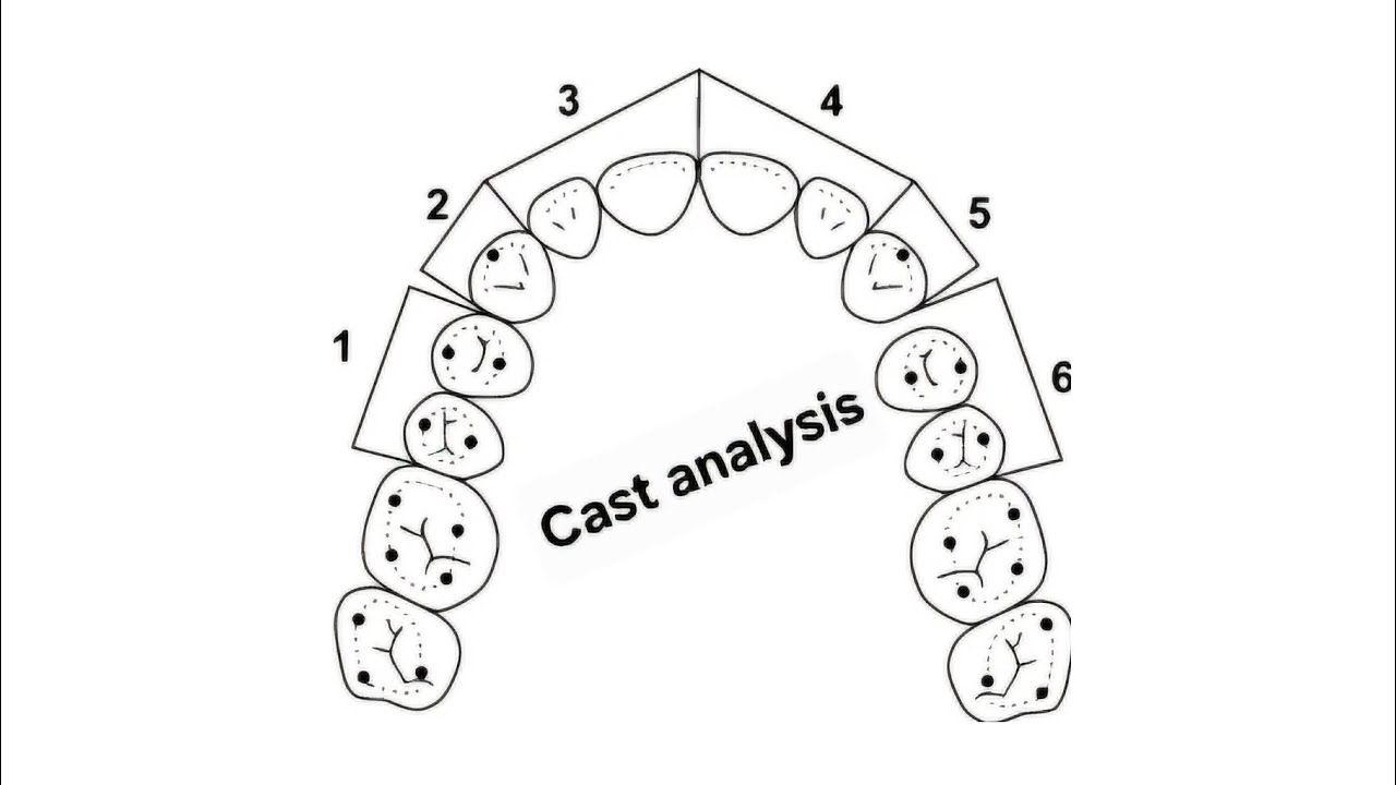 How to make cast analysis for orthodontic treatment plan