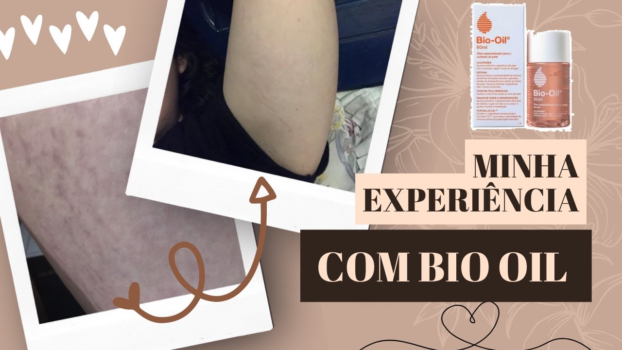 TESTEI O BIO OIL PARA ESTRIAS - MEU ANTES E DEPOIS - Cinara Burckardt