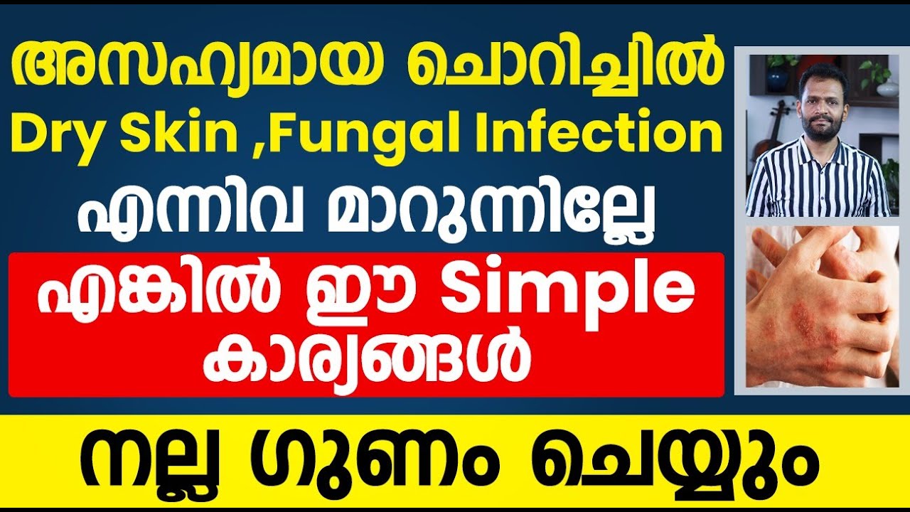 ചൊറിച്ചിൽ,Dry skin,Fungal Infection എന്നിവ മാറുന്നില്ലെങ്കിൽ ഇങ്ങനെ ചെയ്ത് നോക്കു|dry skin|chorichil