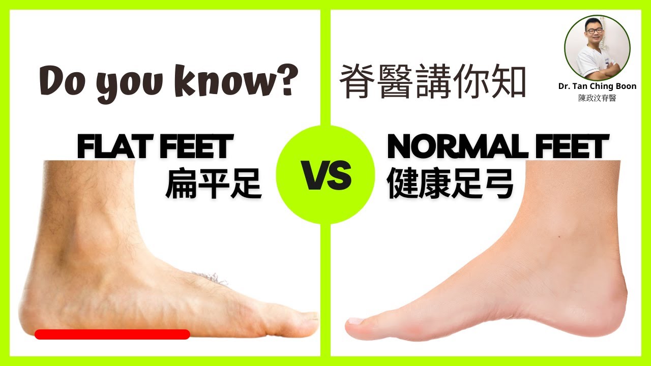 [Eng/中文] Do you know? Flat feet VS Normal feet🦶🏻導致扁平足的成因主要分為結構性和功能性，兩者對於日常生活有什麼影響？