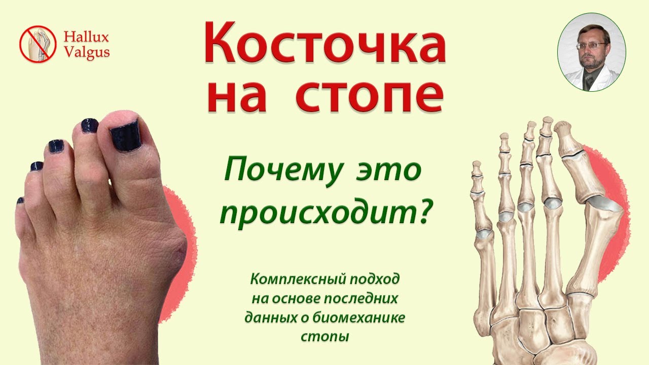 Косточки на стопе.  Причины.