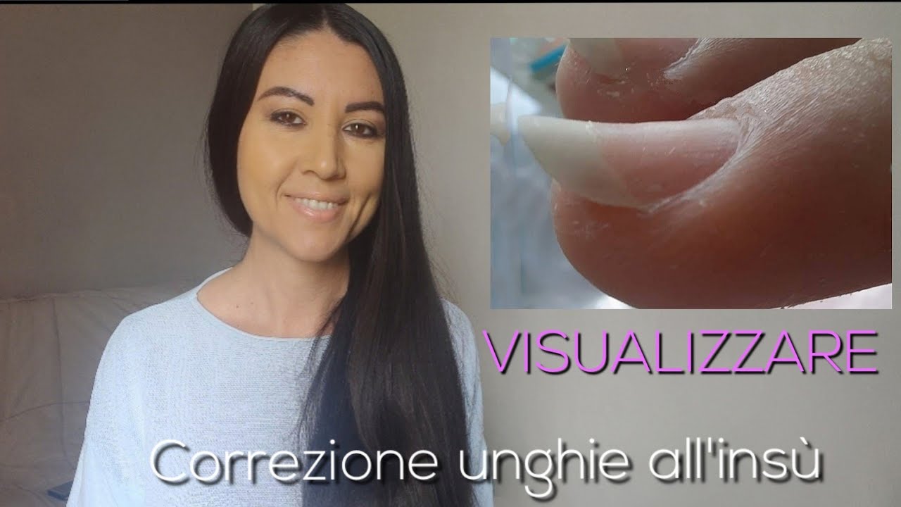 Visualizzare💅 - Lezione 5: Correggere le unghie che crescono verso l'alto  - Ep. 38