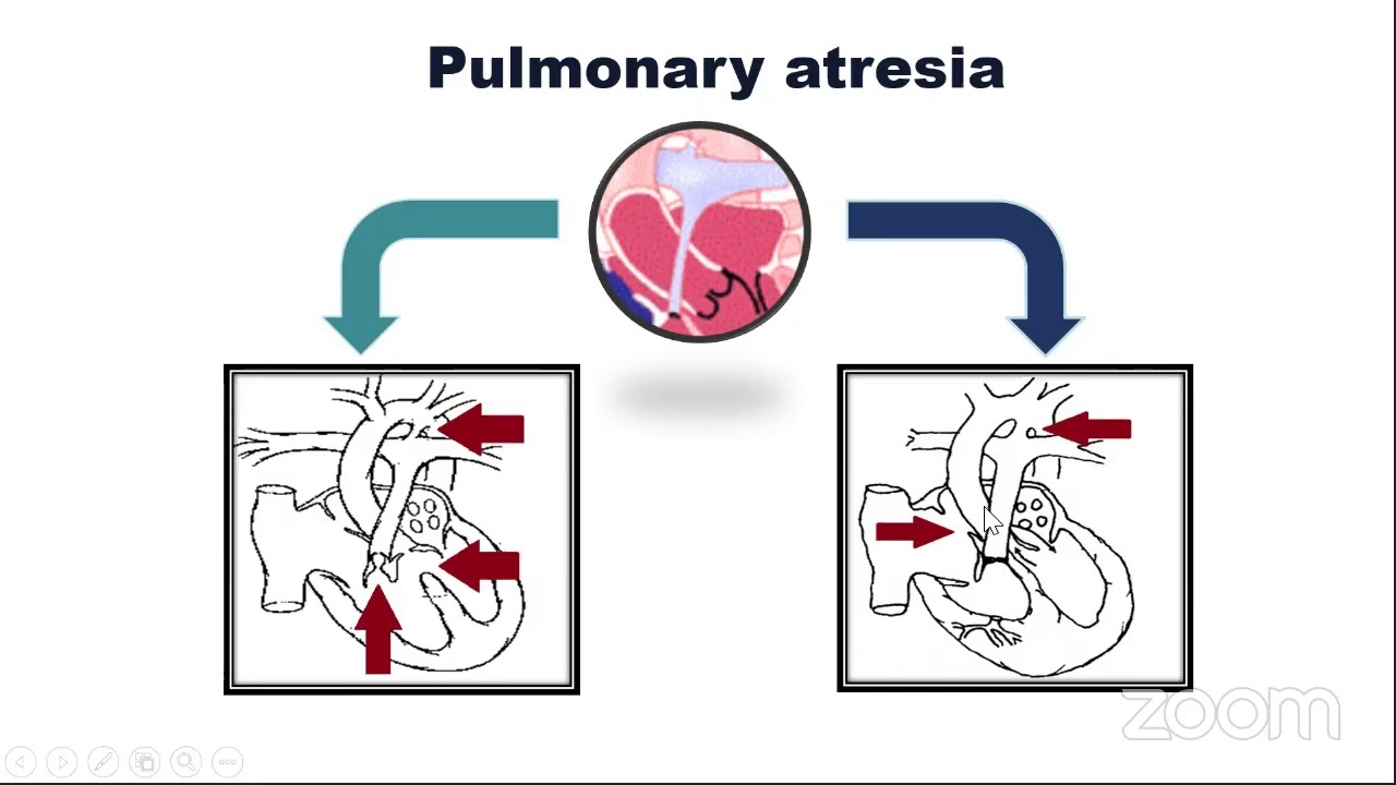 CHD@CEC, Webinar 7, Right Side Obstructive Lesions