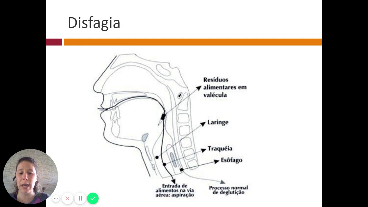 Disfagia na Doença de Parkinson