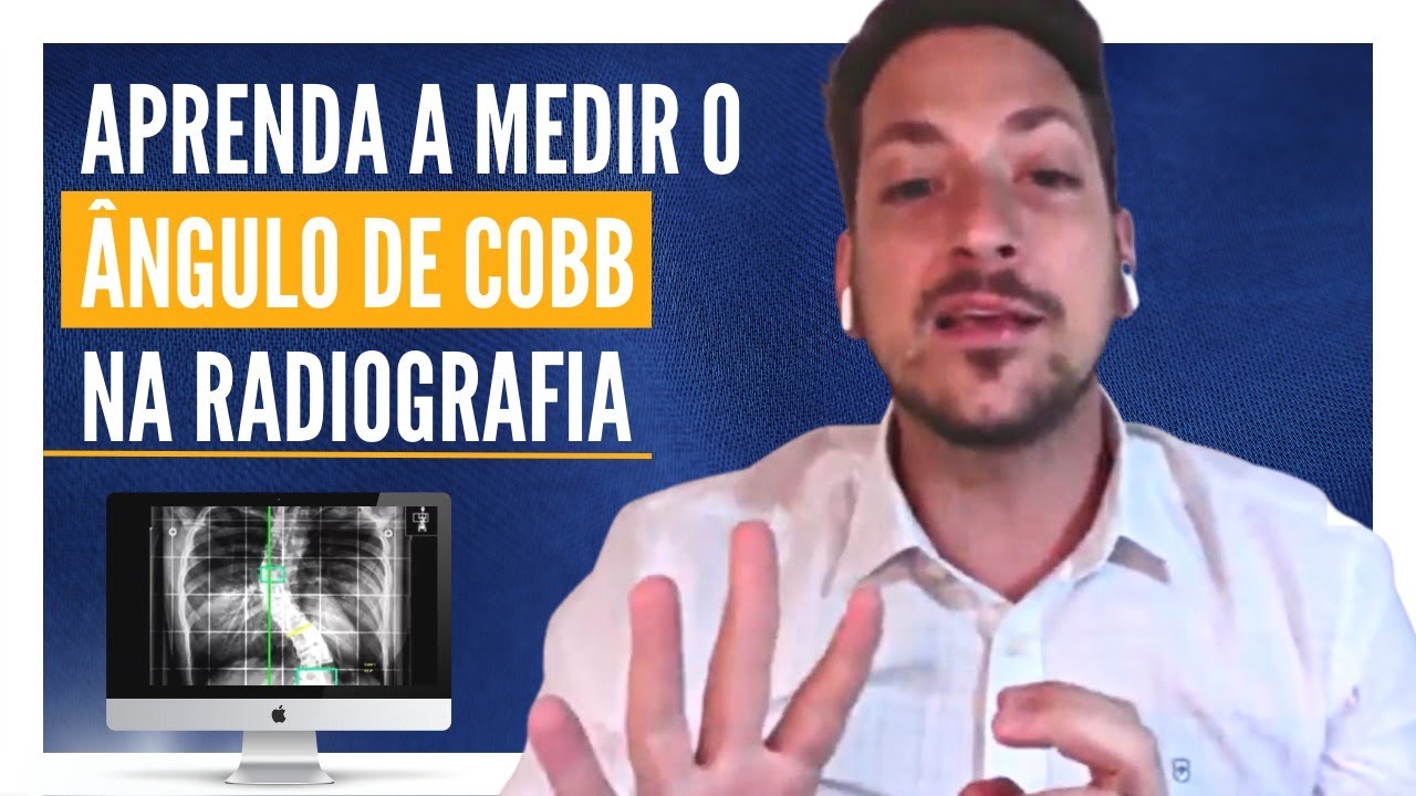 ESCOLIOSE: APRENDA A MEDIR O ÂNGULO DE COBB NA RADIOGRAFIA