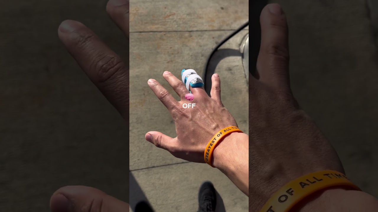 I broke my finger but that didn&rsquo;t stop me! #calisthenics #fitness #motivation