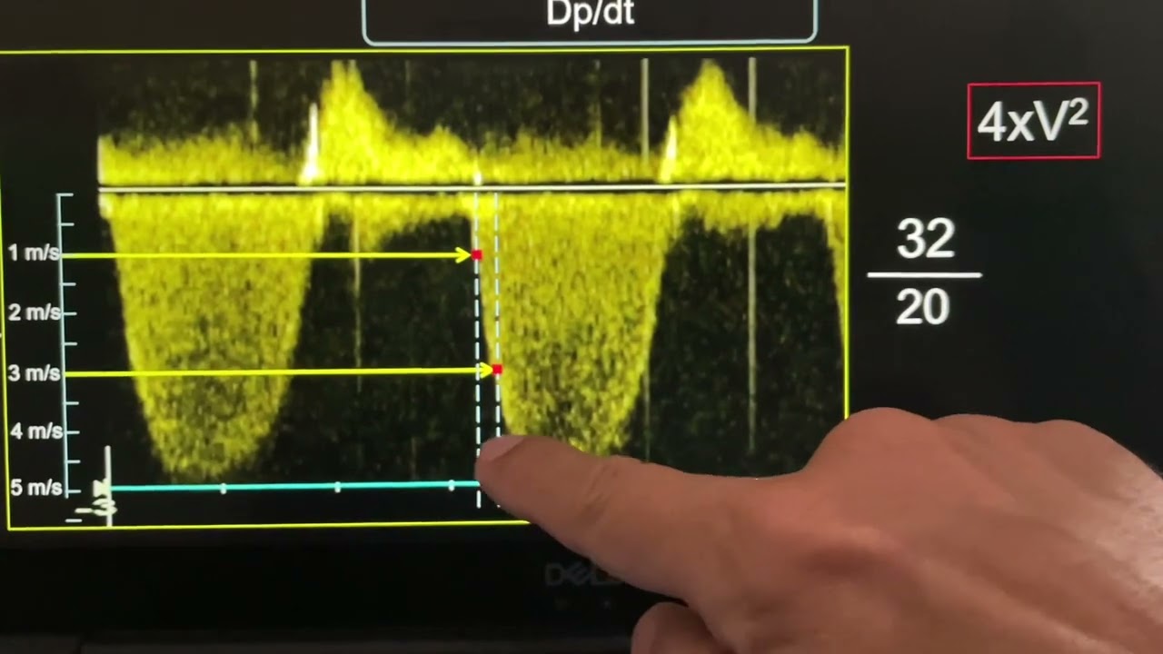 Medición de la Dp/dt por medio de eco Doppler