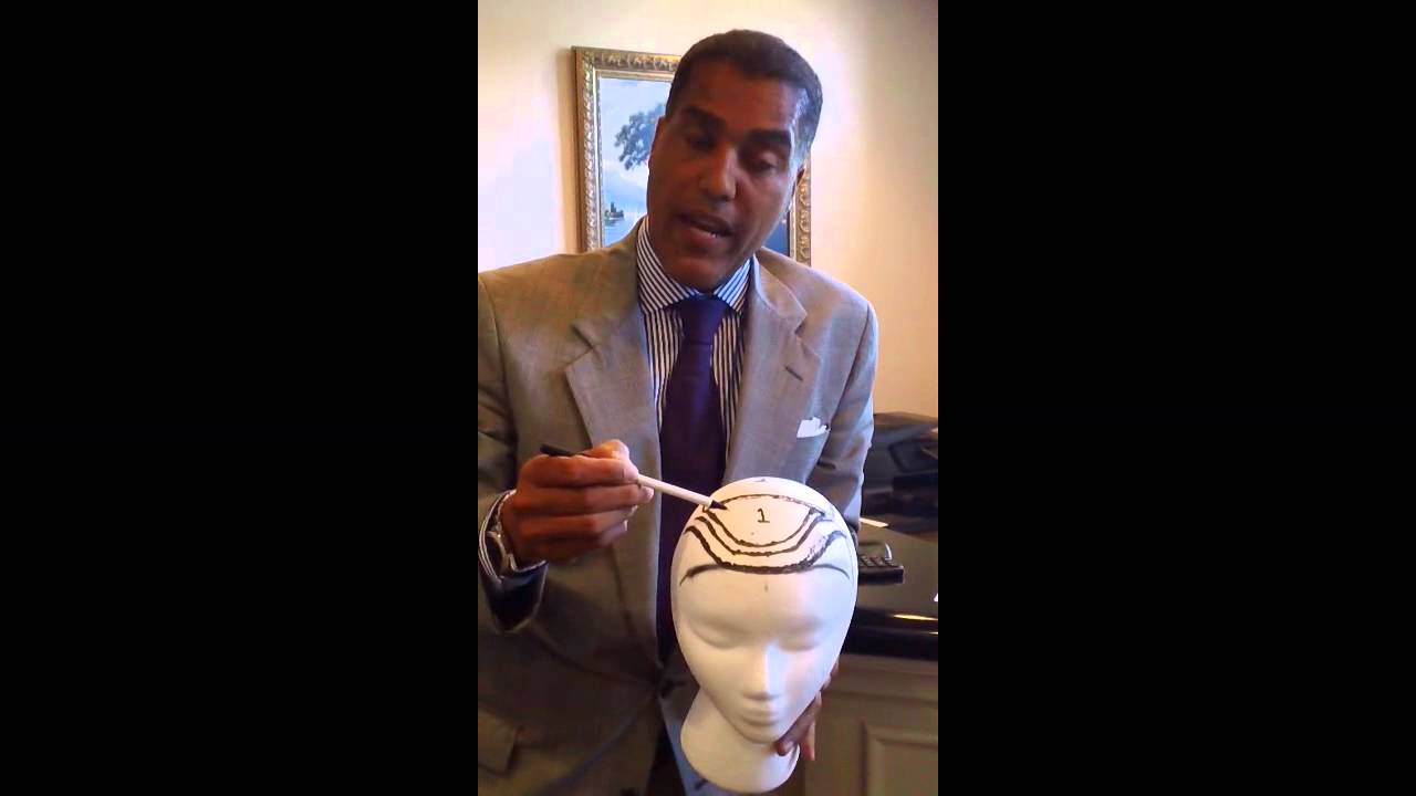 Why do I need 3000 grafts, Doc?