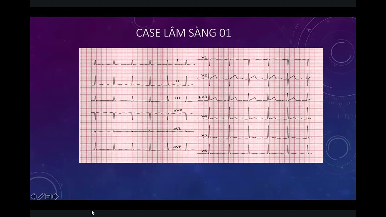 Thực hành điện tâm đồ Block nhĩ thất