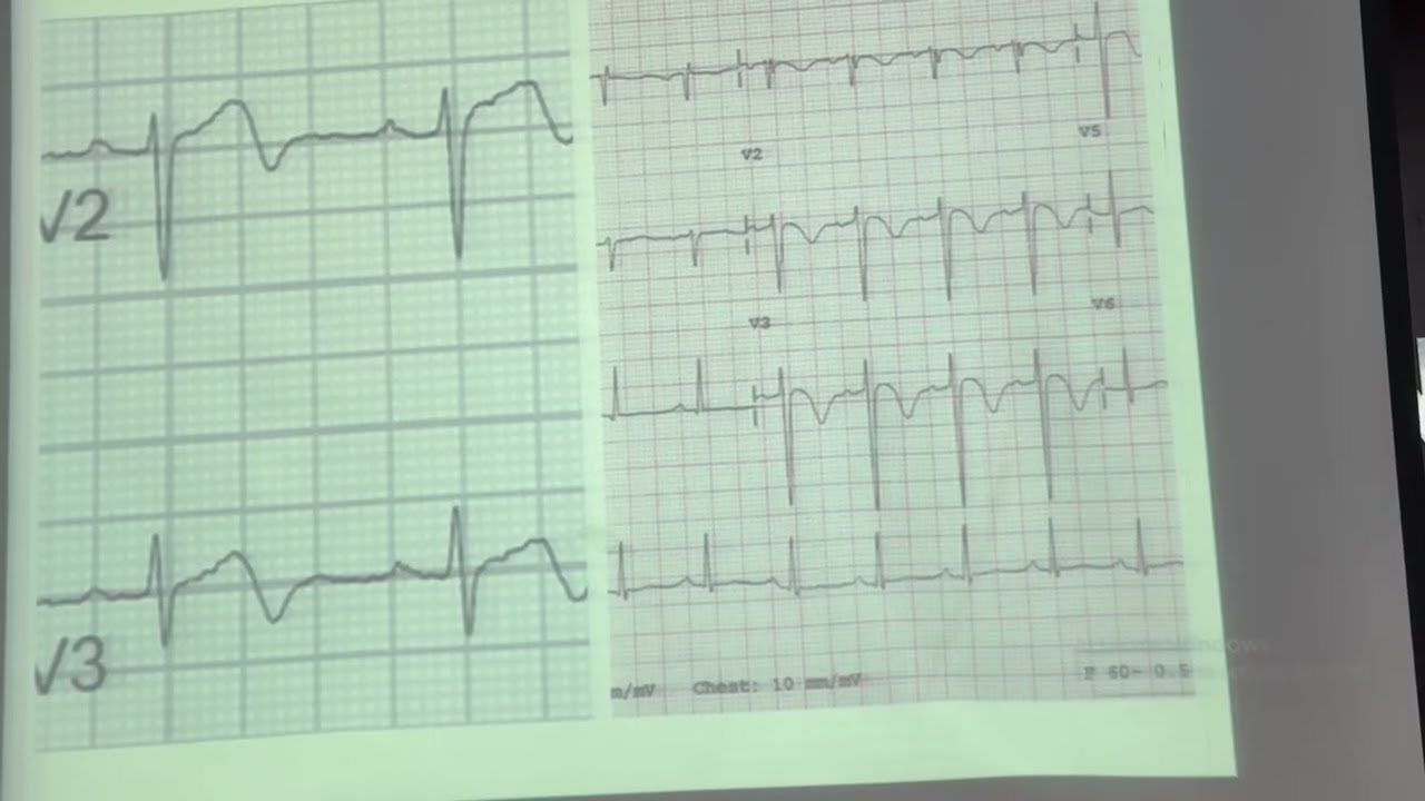 HOW TO APPROACH ECG IN ACTE CHEST PAIN