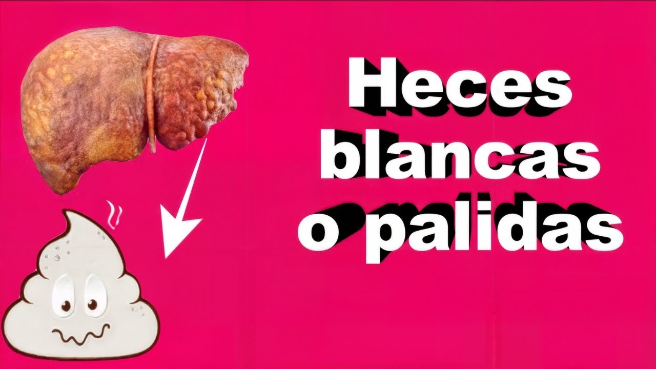 Las Heces Blancas o P&aacute;lidas son PELIGROSAS &iquest;Deber&iacute;a preocuparme?