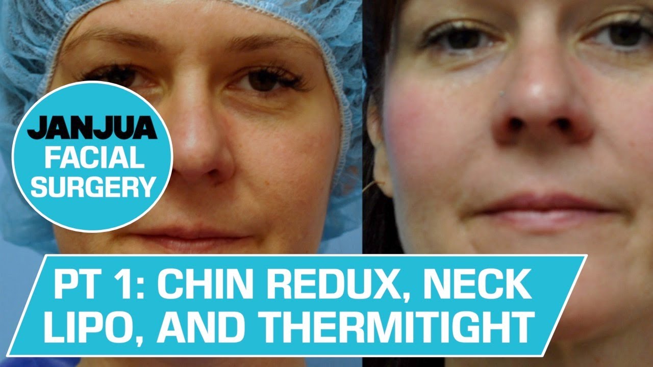 PART 1: CHIN REDUCTION, NECK LIPOSUCTION, AND THERMITIGHT - DR. TANVEER JANJUA - NEW JERSEY