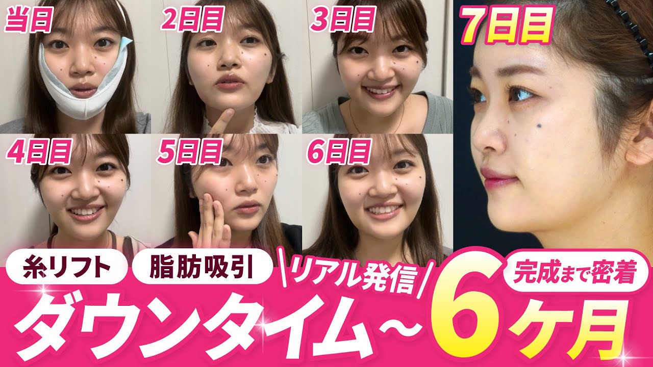 【20代小顔ダウンタイム】20代女性が糸リフト＋顔の脂肪吸引で大変身！その後のリアル6ヶ月を大公開！【湘南美容クリニック/若返りエキスパートドクター高橋承子】